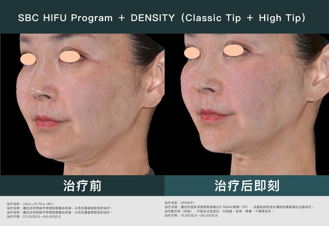 超级推荐与 HIFU联合治疗◎