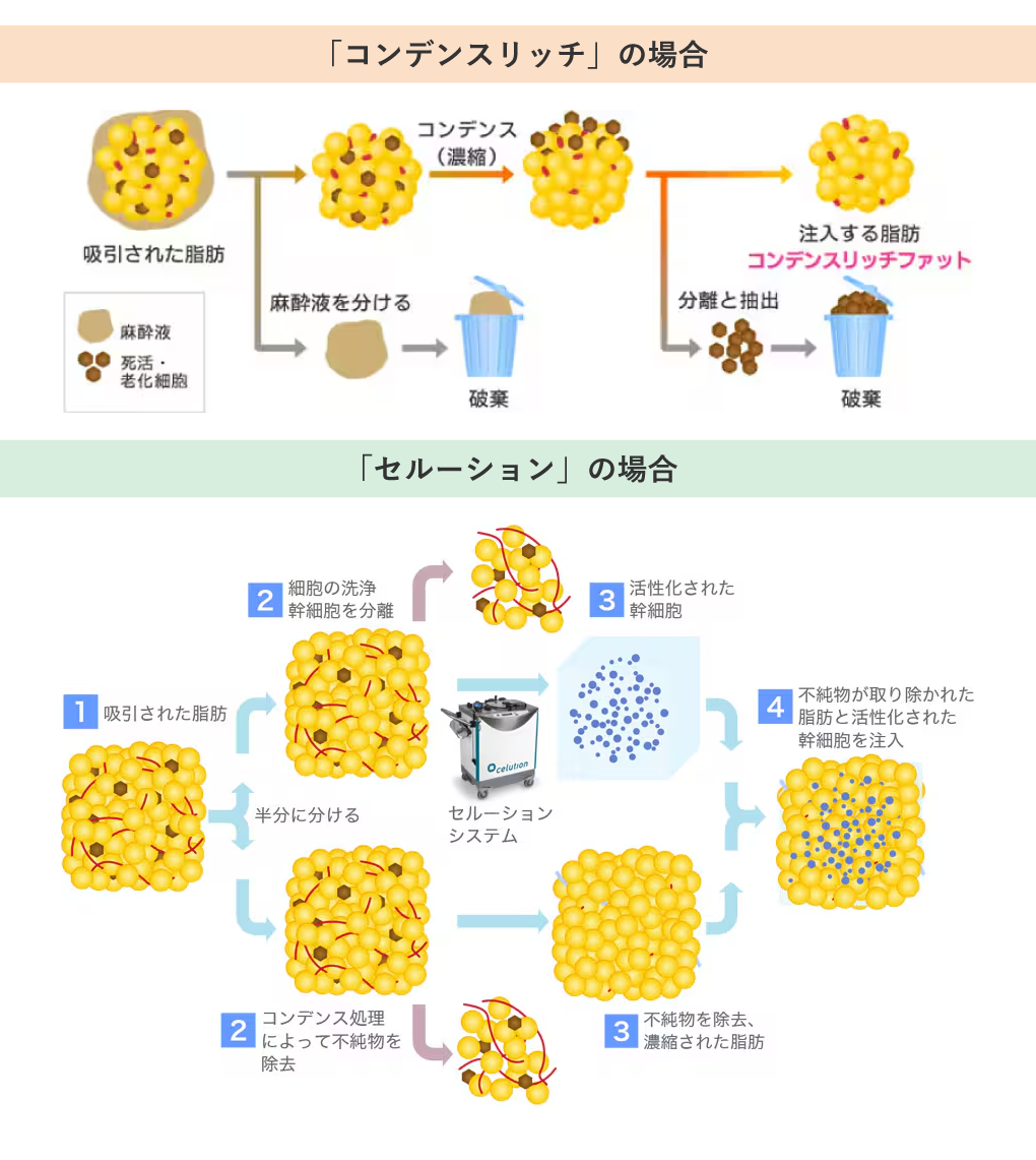 脂肪の採取・処理方法