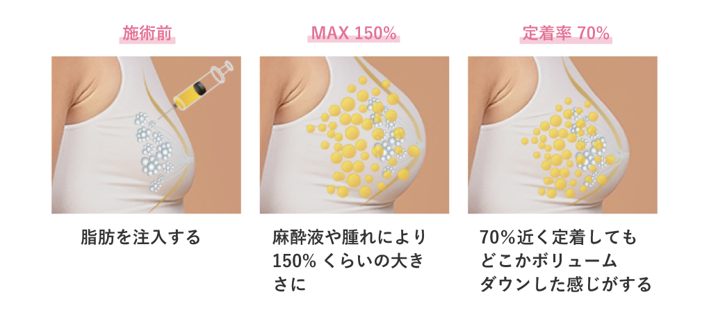 手術直後と完成時の見た目が異なる理由