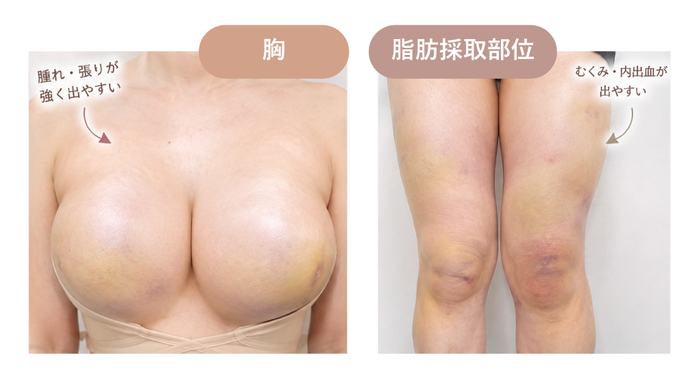 胸と脂肪採取部位では症状が違う