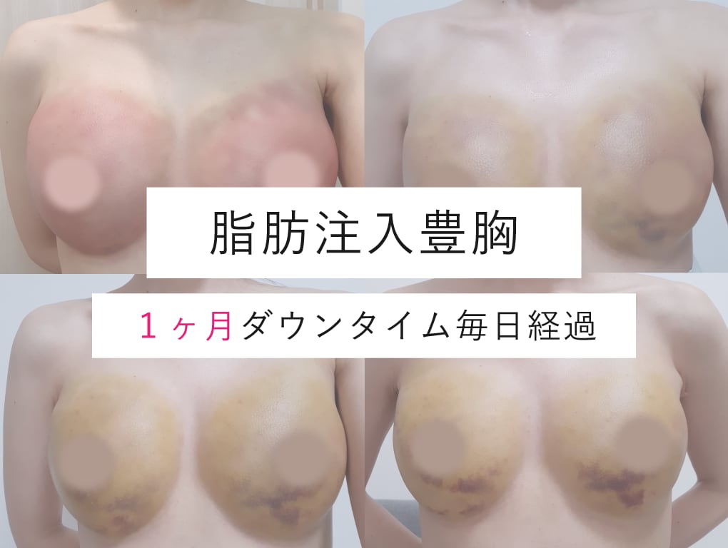 脂肪豊胸ダウンタイム