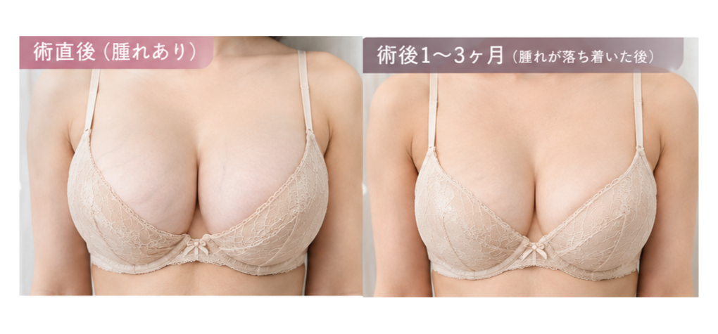 術直後と腫れが落ち着いた後のサイズの違い