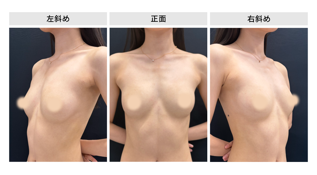 手術前｜バストの状態