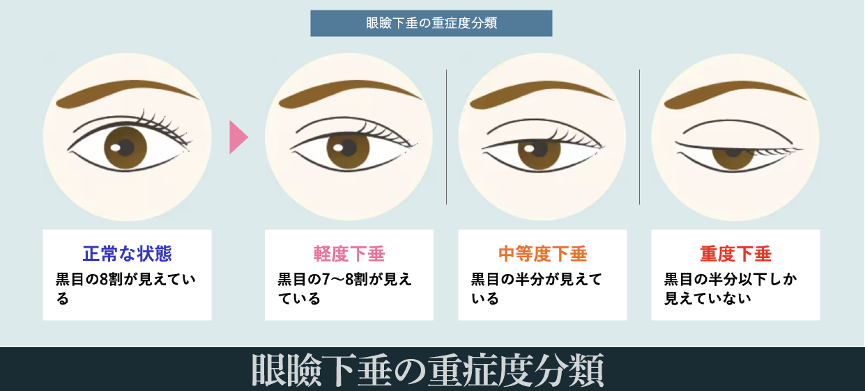 眼瞼下垂の重症度分類