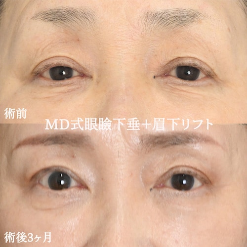 3位　MD式眼瞼下垂＋MD式眉下リフト