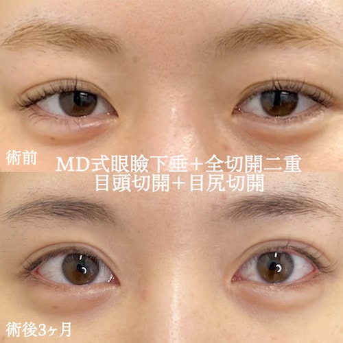 1位　MD式眼瞼下垂＋MD式全切開二重術
