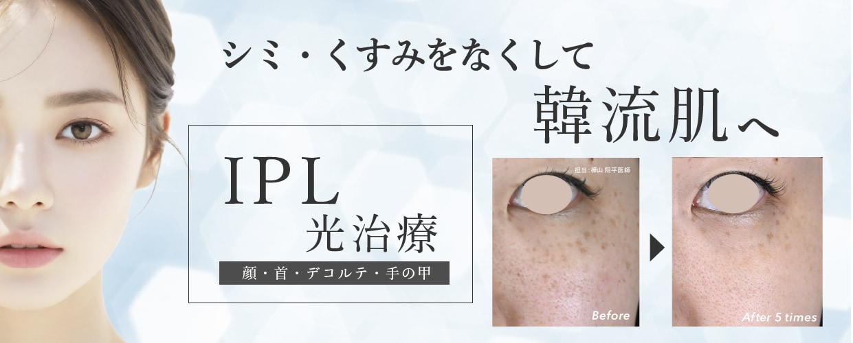 老けみえの原因のシミやくすみを無くして透明感溢れるお肌へ＜IPL光治療（フォトダブル・フォトトリプル）＞