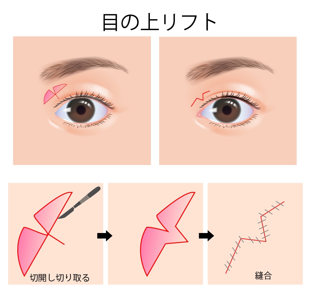 目の上リフト
