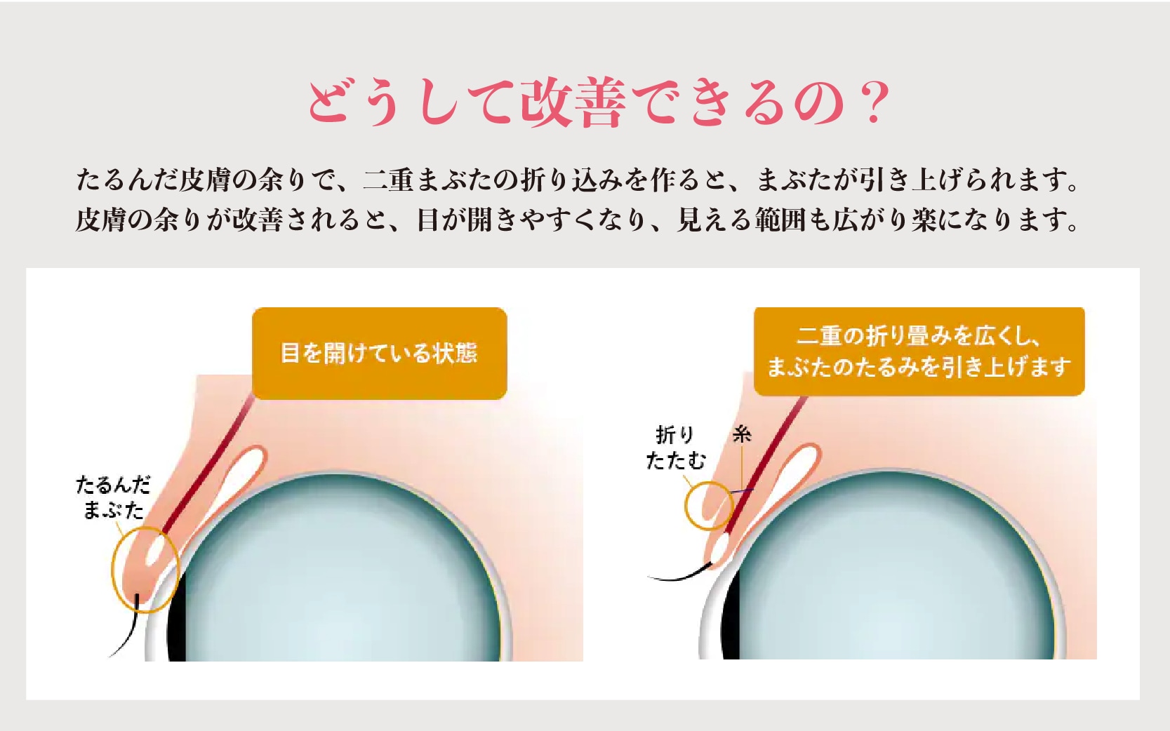 見た目だけでなく機能面での改善効果が期待できる二重術