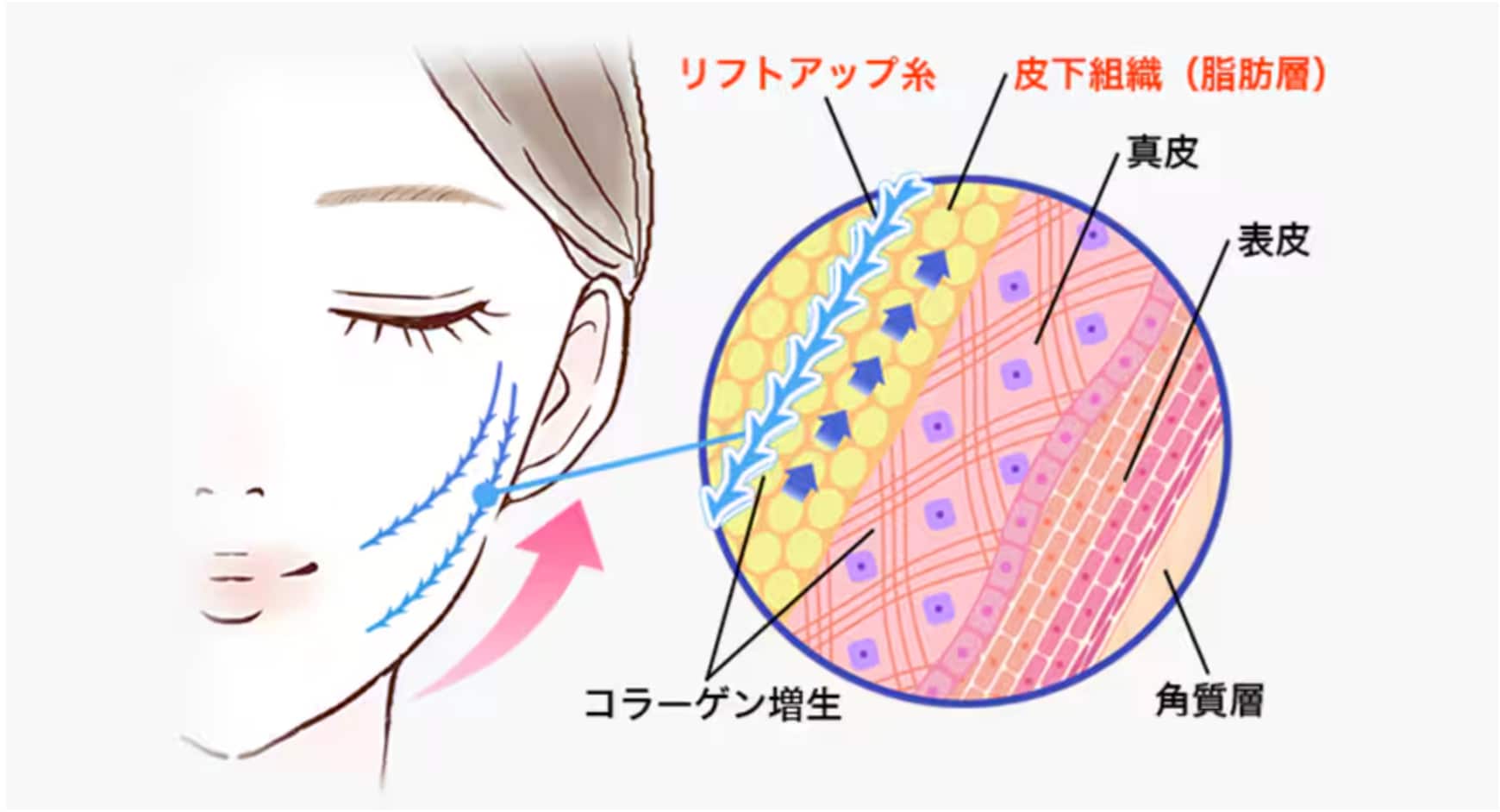 切らずにできるお手軽な小顔術！！