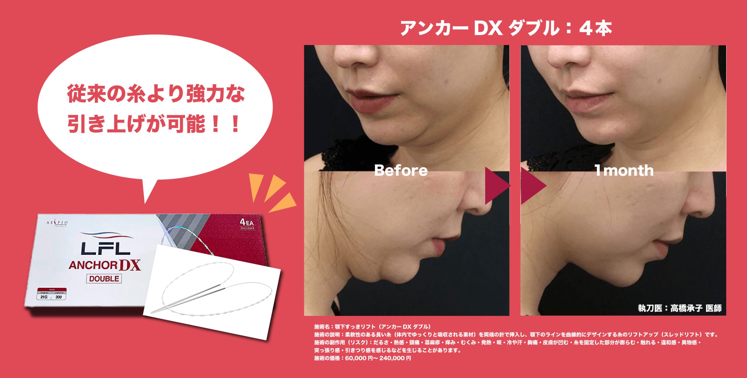 糸リフトを使用して二重アゴ改善‼️