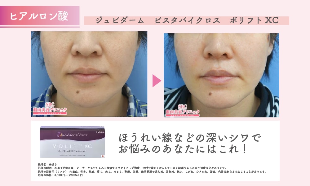 💎ヒアルロン酸注入💎
