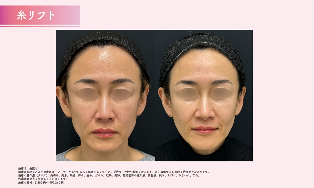 💎糸リフト💎