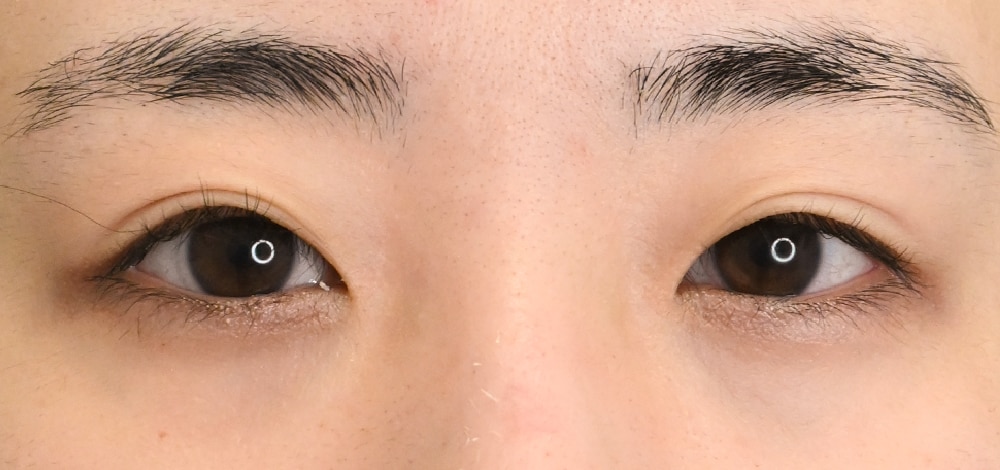 👀 ② ラインが薄く・ぼやけてきた