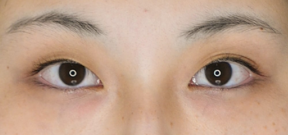 👀 ④ 片目だけ一重に戻る瞬間がある