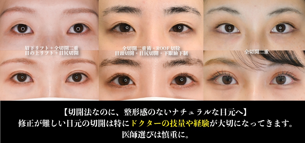 修正が難しい切開はドクター選びが更に大切になってきます。
