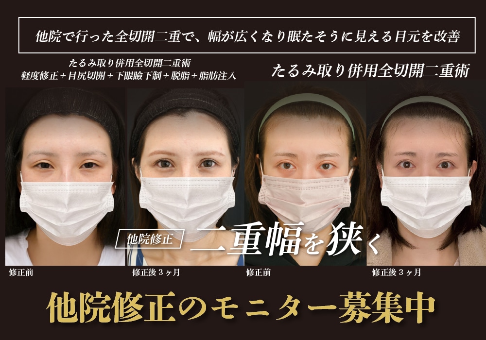 他院修正・修正手術の症例モニターを募集しています