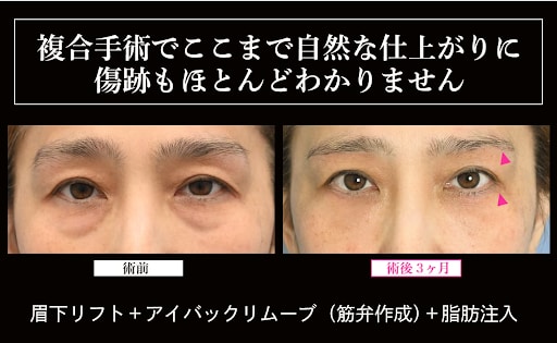 施術内容：眉下リフト＋眼瞼下垂
