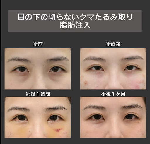 お悩み：くぼみとふくらみが気になる　施術：【目の下の切らないクマたるみ取り+脂肪注入】