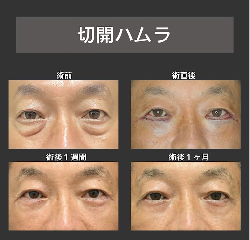 皮膚のたるみが強く、ふくらみが大きくある方【切開ハムラ】