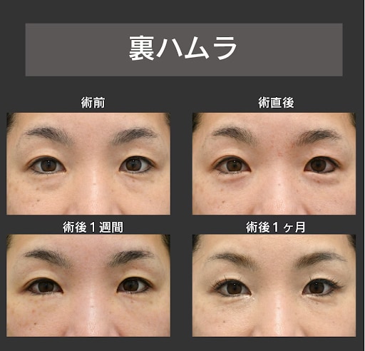 くぼみとふくらみがあり脂肪採取、注入に抵抗がある方【裏ハムラ】