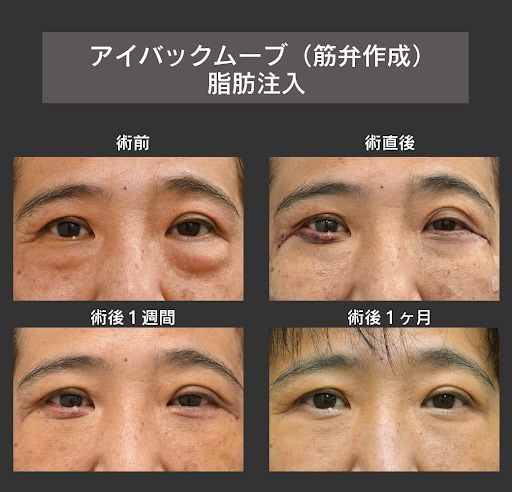 皮膚のたるみが強くある方【アイバックリムーブ（筋弁作成）+脂肪注入】