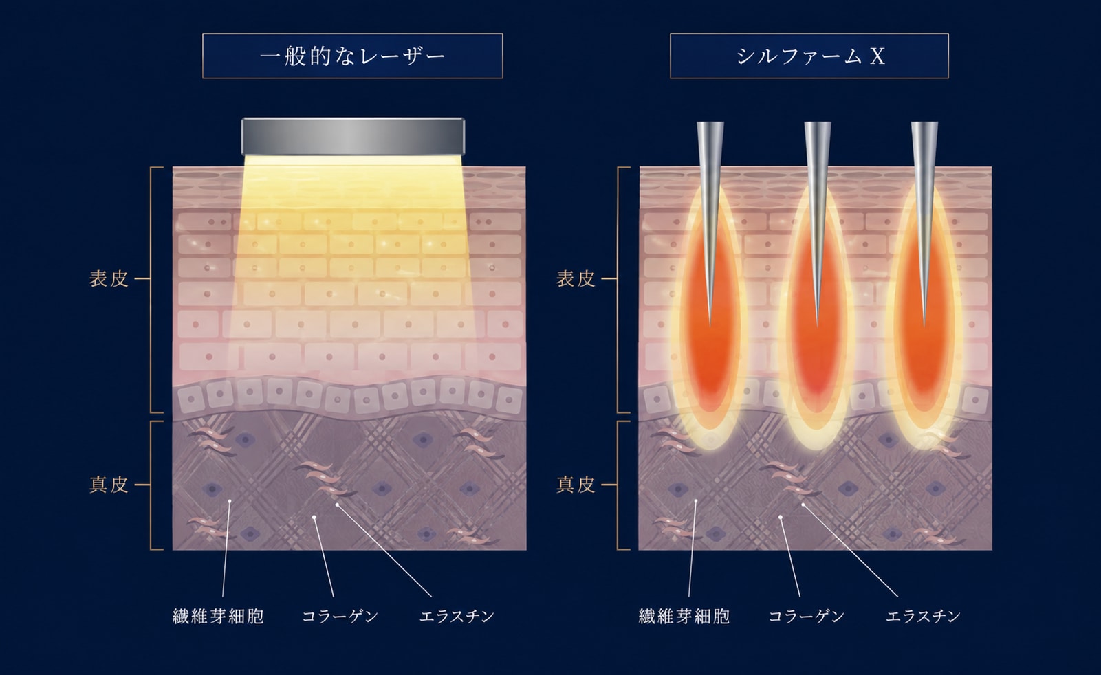 「微細な針」✖️「RF（高周波）」のダブル効果