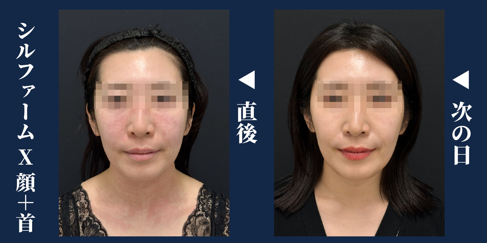 ダウンタイムが短いのも人気の理由