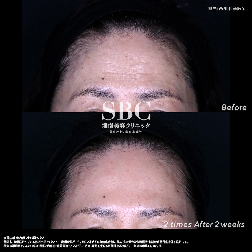 シワ・たるみなど、年齢とともに増えていく肌悩みにアプローチ。<br />
気になる部分や肌状態に合わせて、必要な美容医療を選択します✨