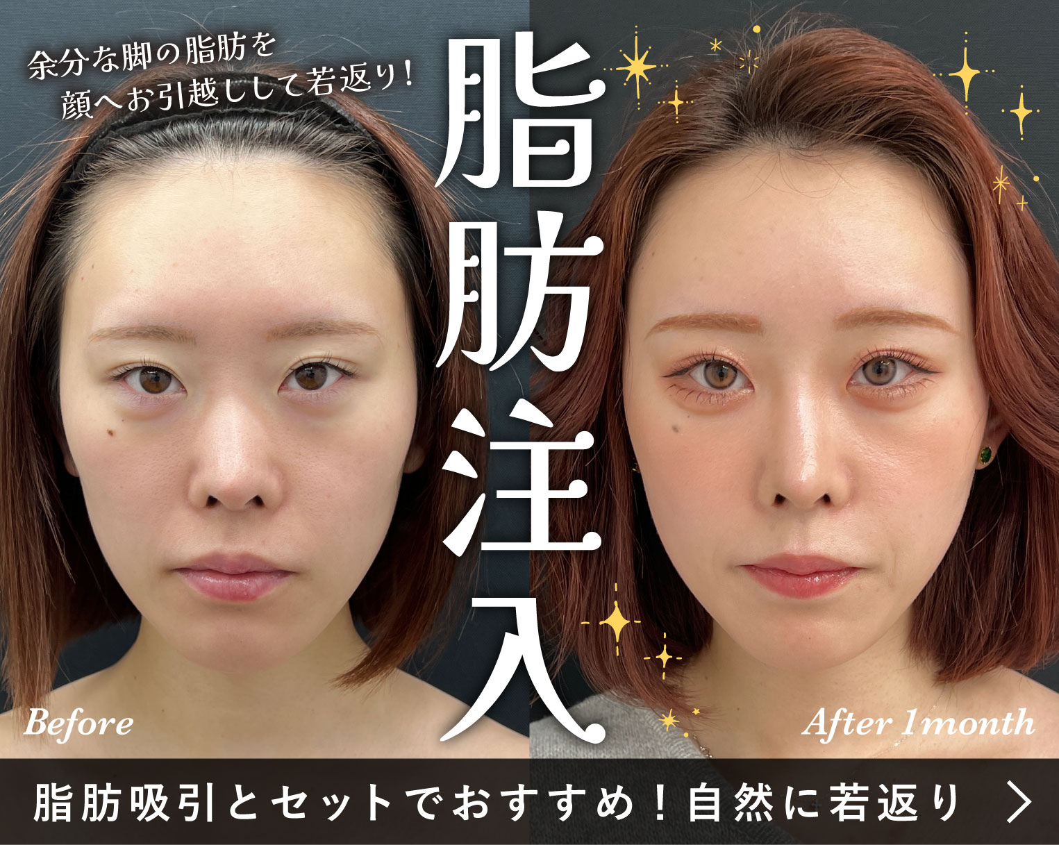 脂肪吸引・脂肪豊胸するなら絶対見て！その脂肪、お引越ししませんか？