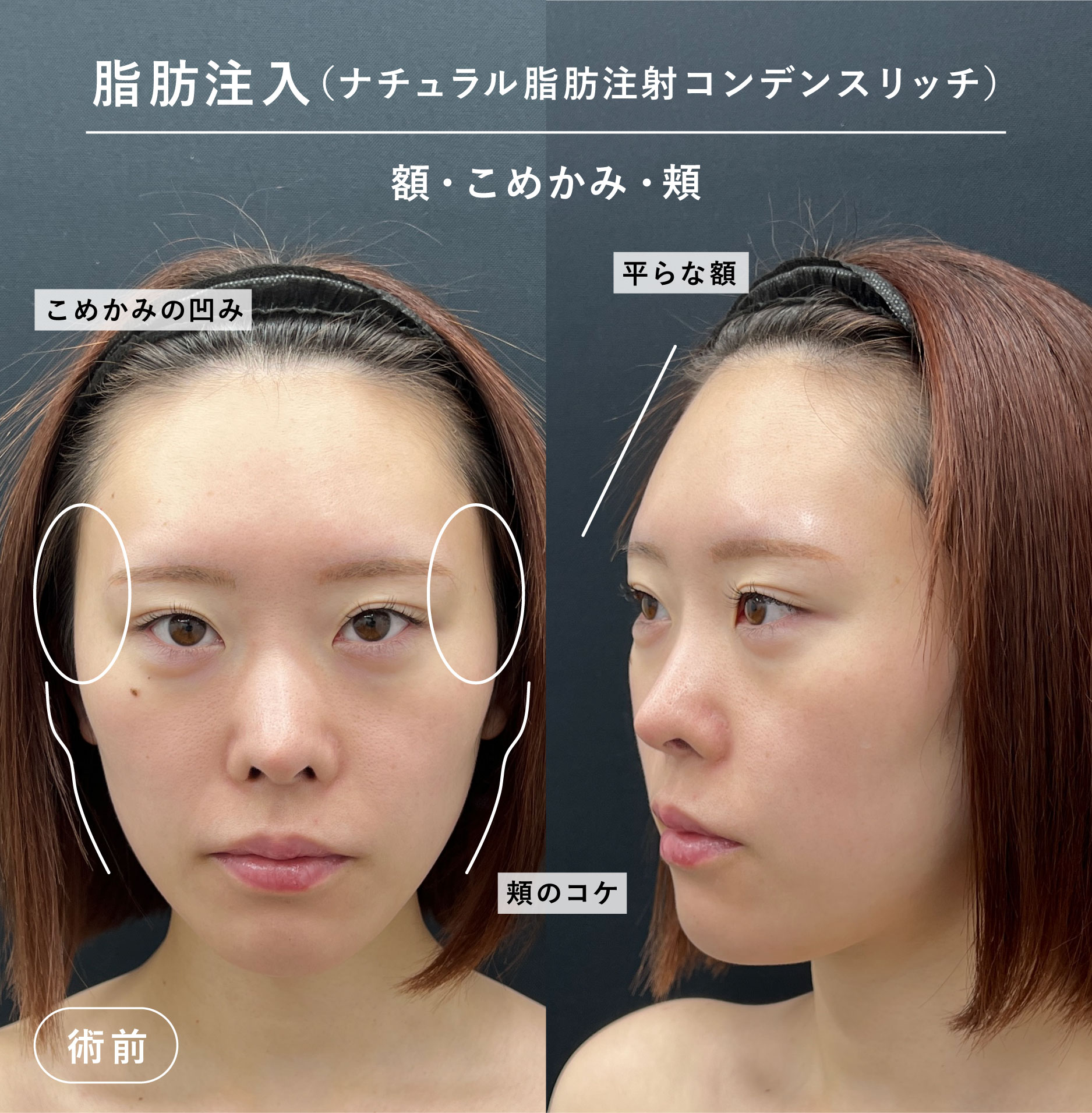 術前