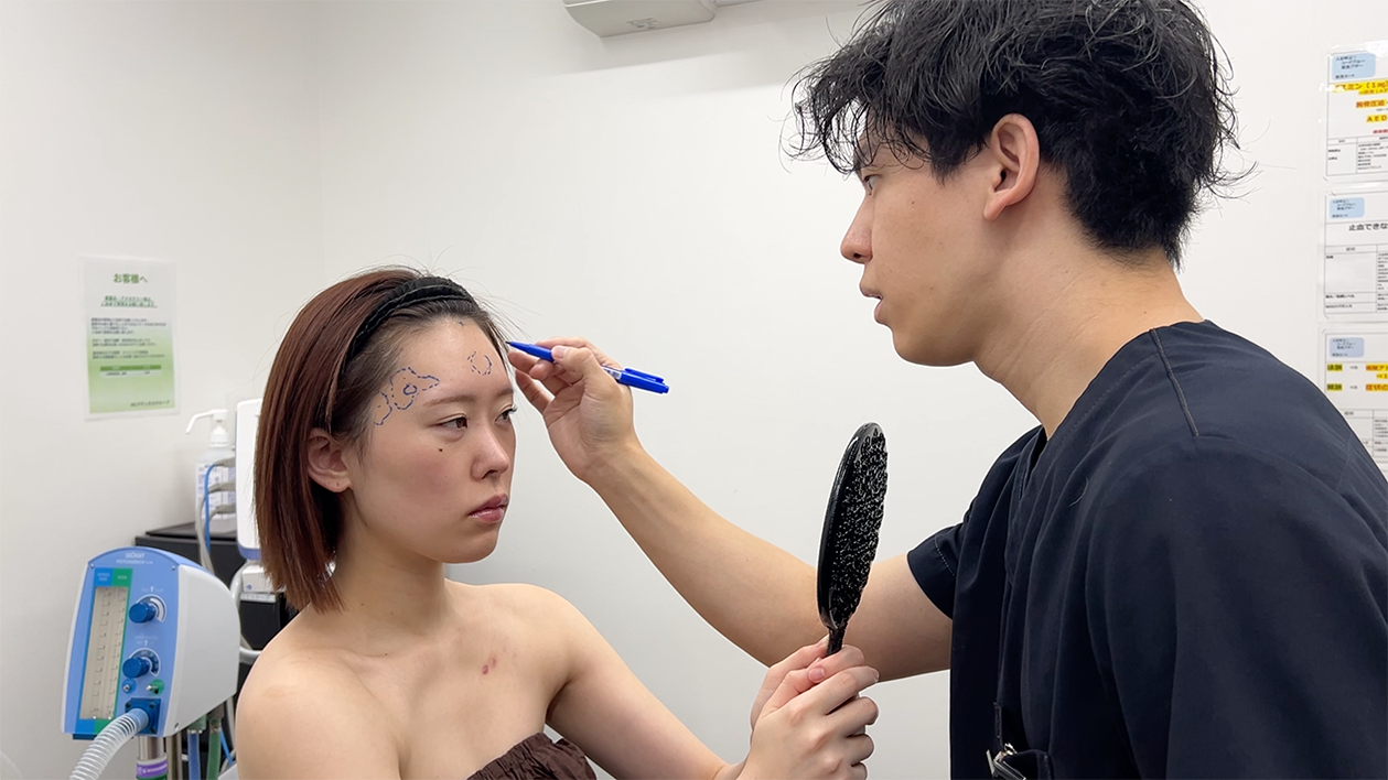 脚の脂肪吸引→ お顔に脂肪注入した方の経過をご紹介