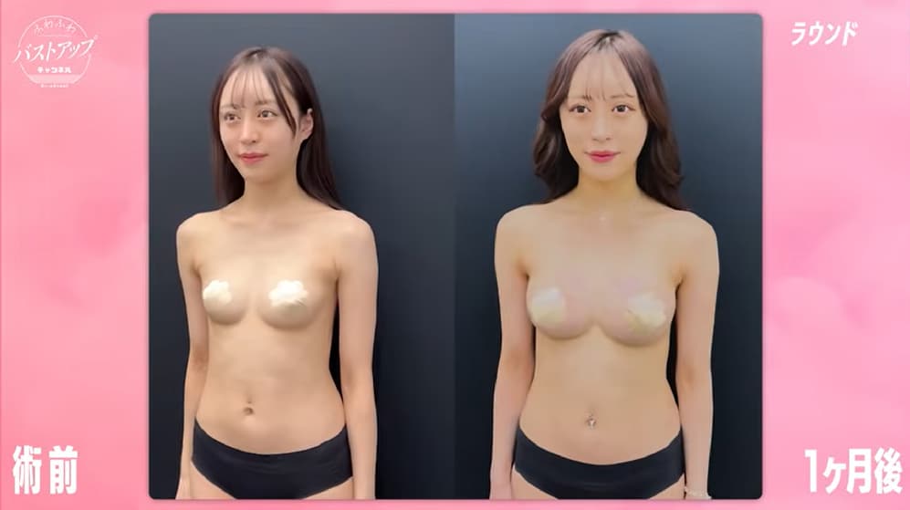 術前・術後１ヶ月比較