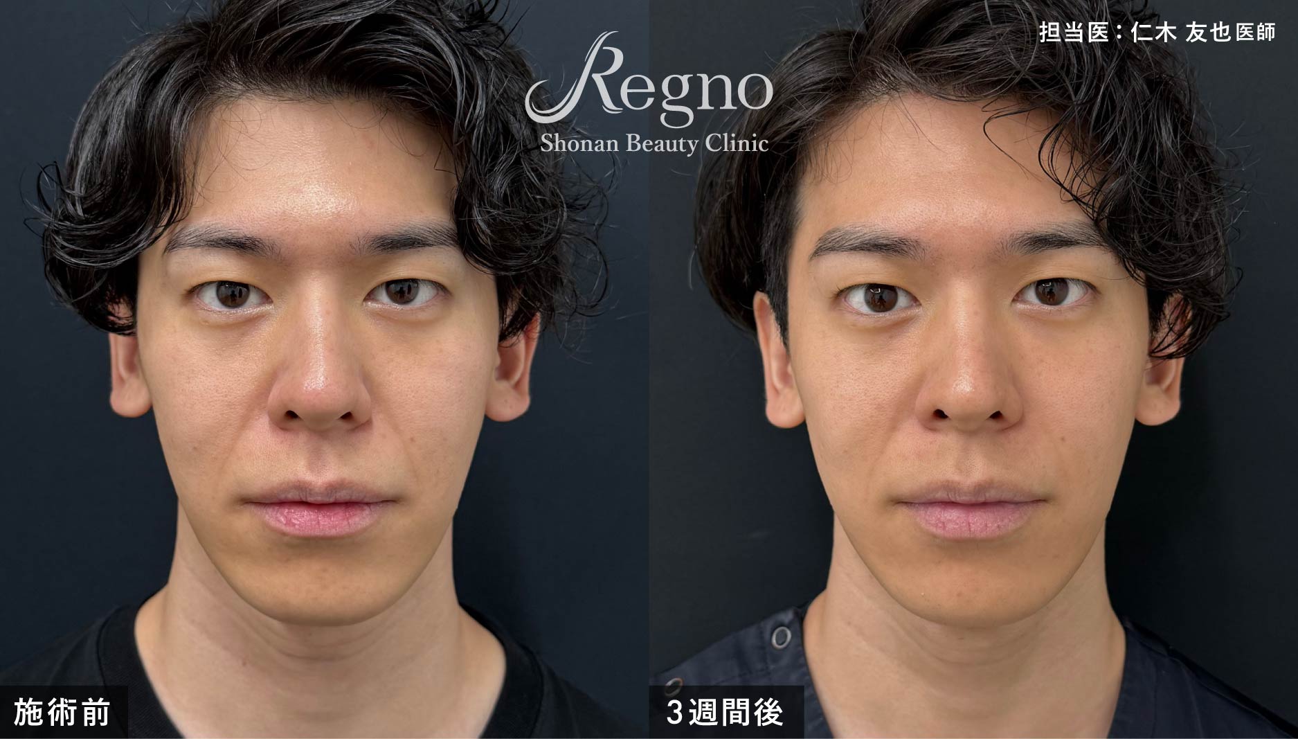 大谷先生のビフォーアフター