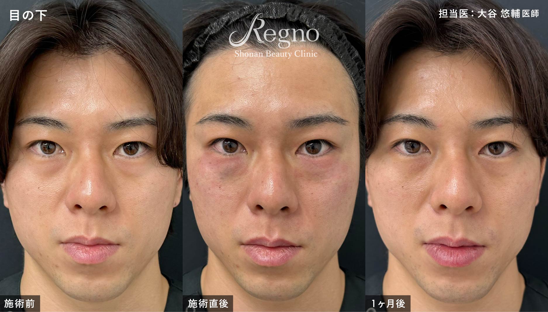 目の下 ビフォーアフター
