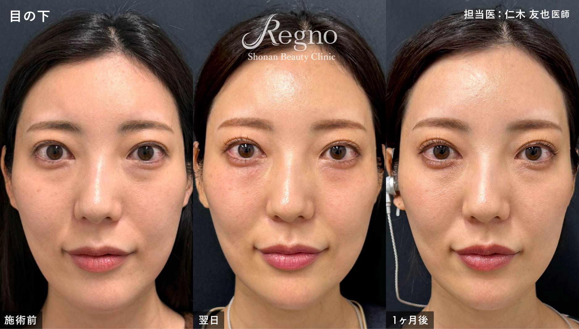 目の下 ビフォーアフター その2