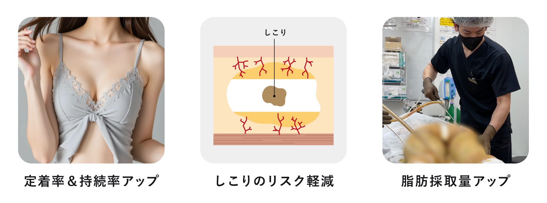 セルーション(セリューション)豊胸のメリット