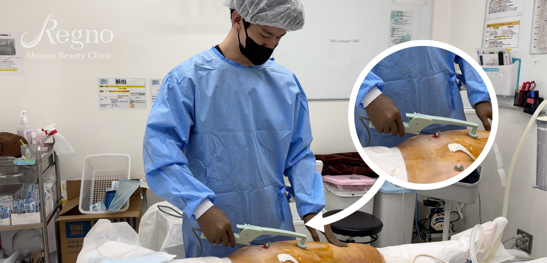 脂肪吸引の修正に欠かせない施術・エンブレイスRF