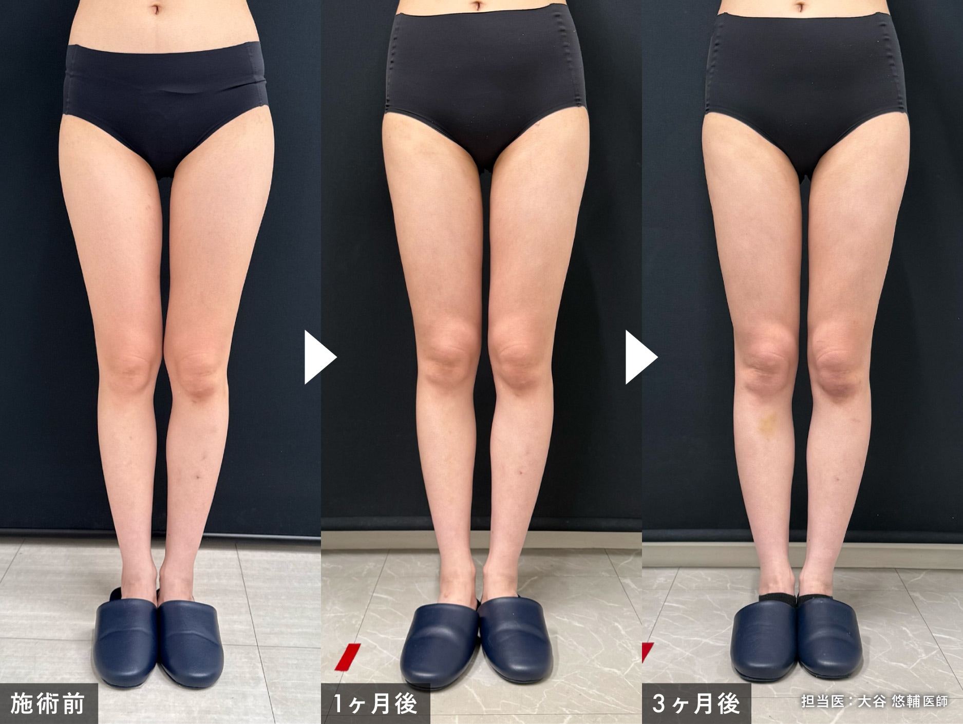 大谷医師の他院修正例・その2