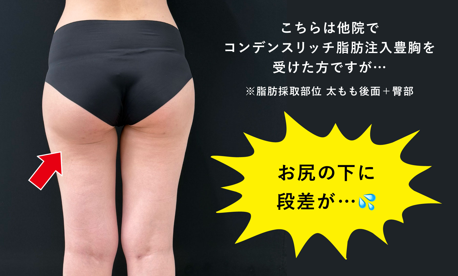 他院の脂肪吸引で失敗してしまった方