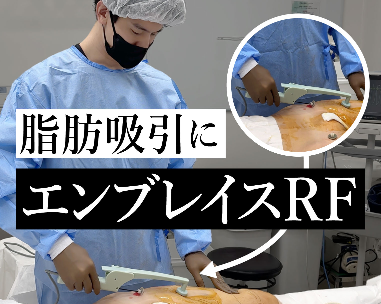 脂肪吸引を受ける人は絶対見て！エンブレイスRFがおすすめな理由