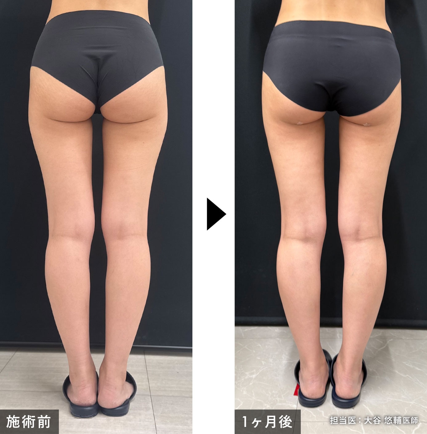 脚の脂肪吸引＋エンブレイスRFの症例写真