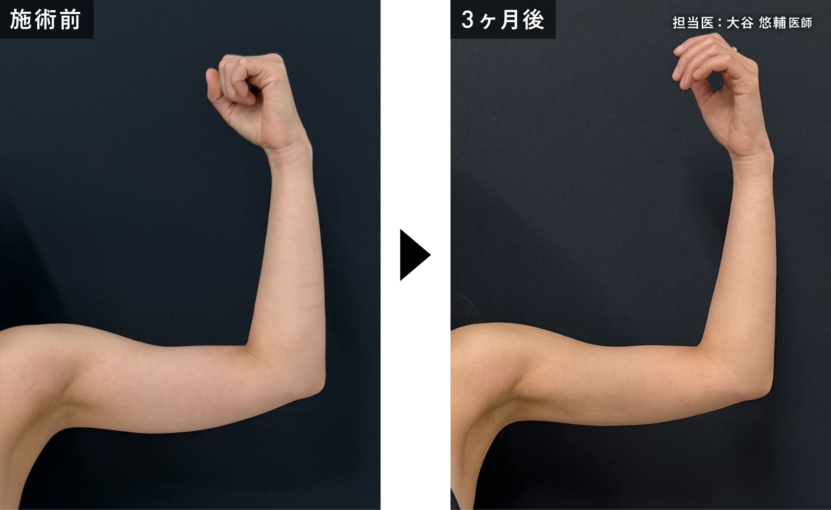 二の腕の脂肪吸引＋エンブレイスRFの症例写真