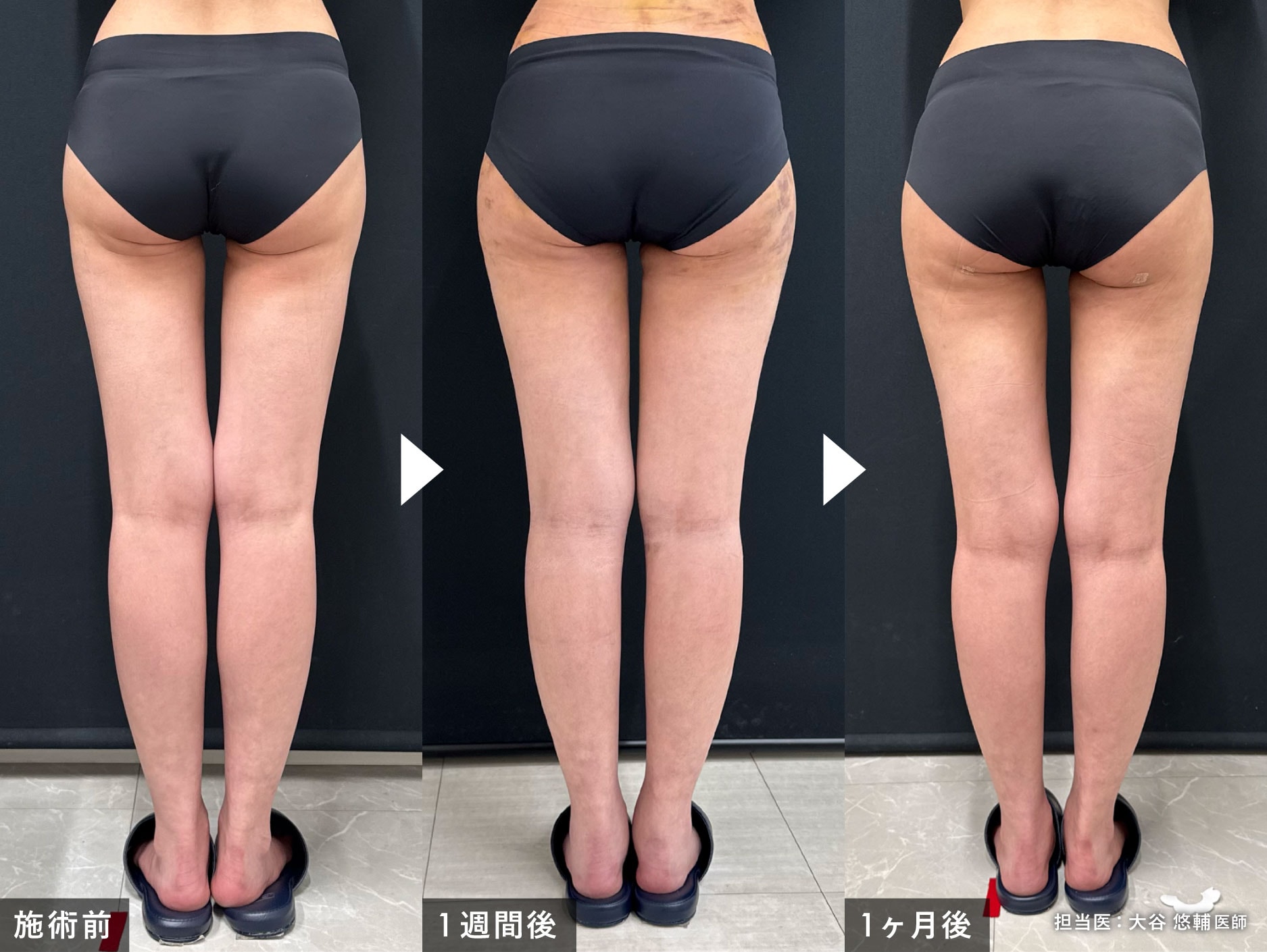 大谷医師の他院修正例・その1