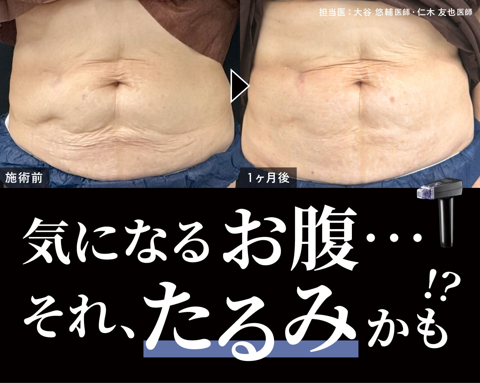 気になるお腹の脂肪、実はたるみかも？モフィウス8でお手軽に理想のボディへ✨