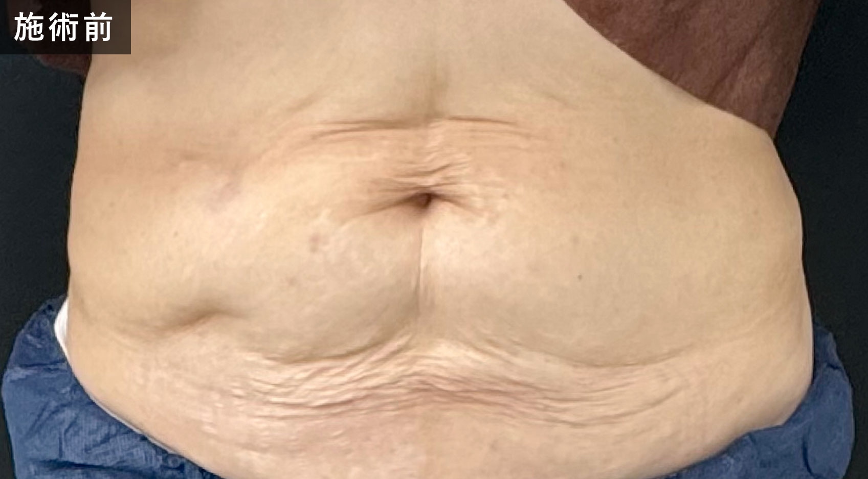 お腹へモフィウスボディを受けた方のビフォーアフター