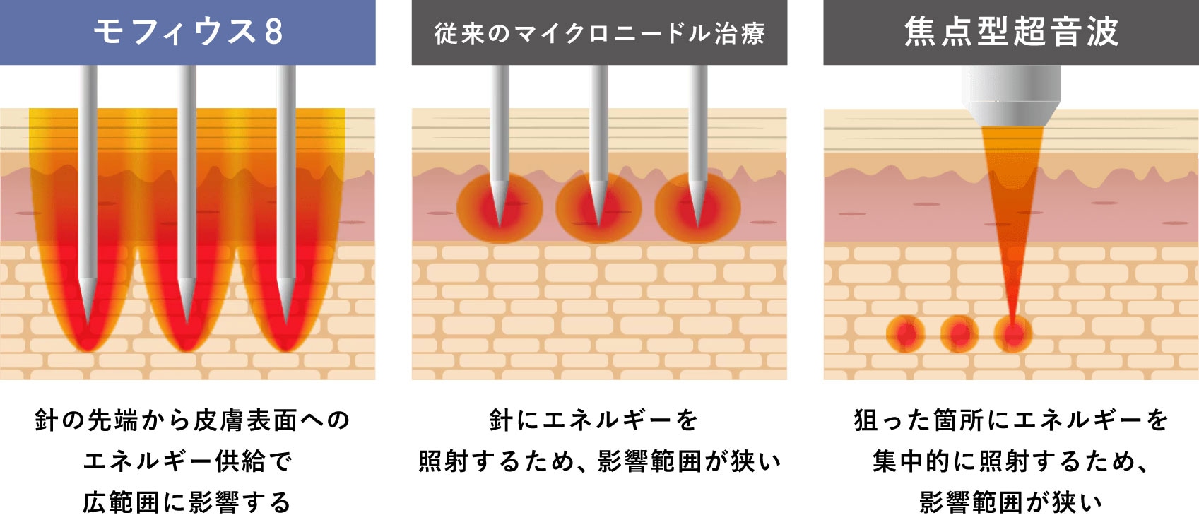 ダウンタイムが軽いのに効果実感◎