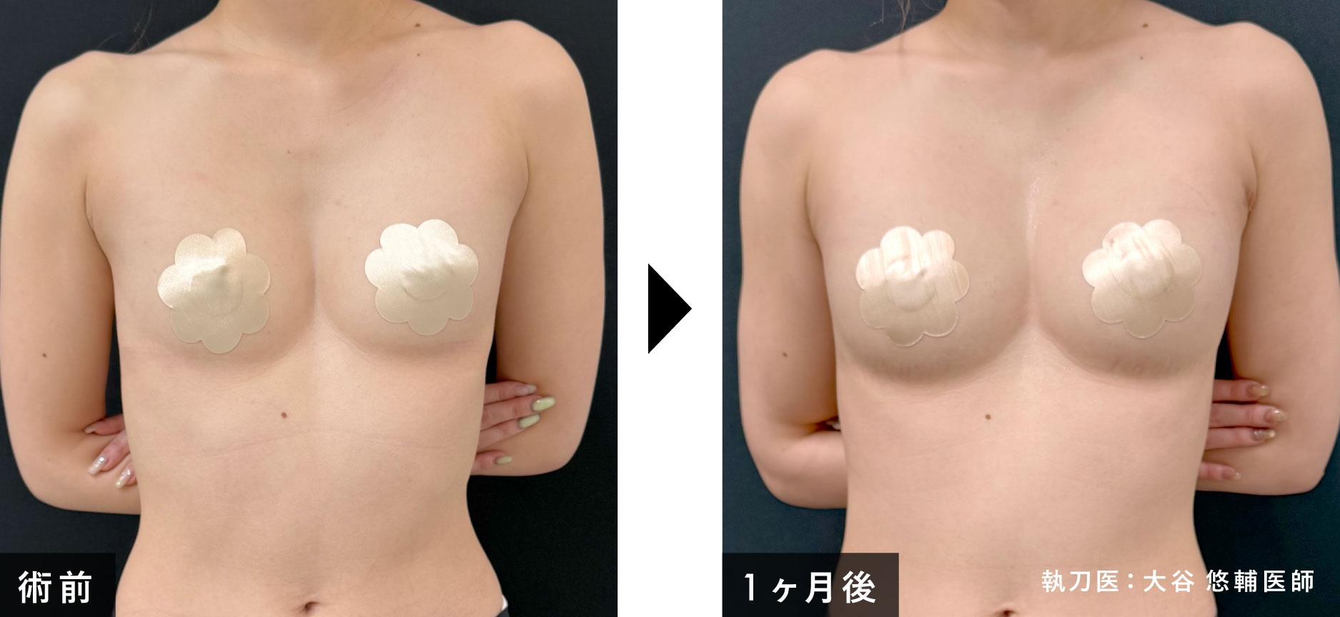漏斗 胸 写真