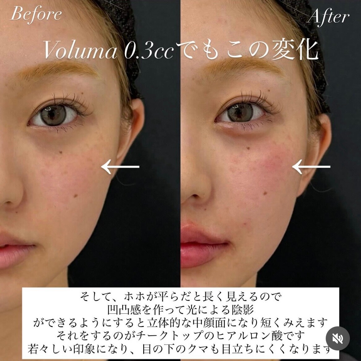 立体感を作り錯覚で短く見せる