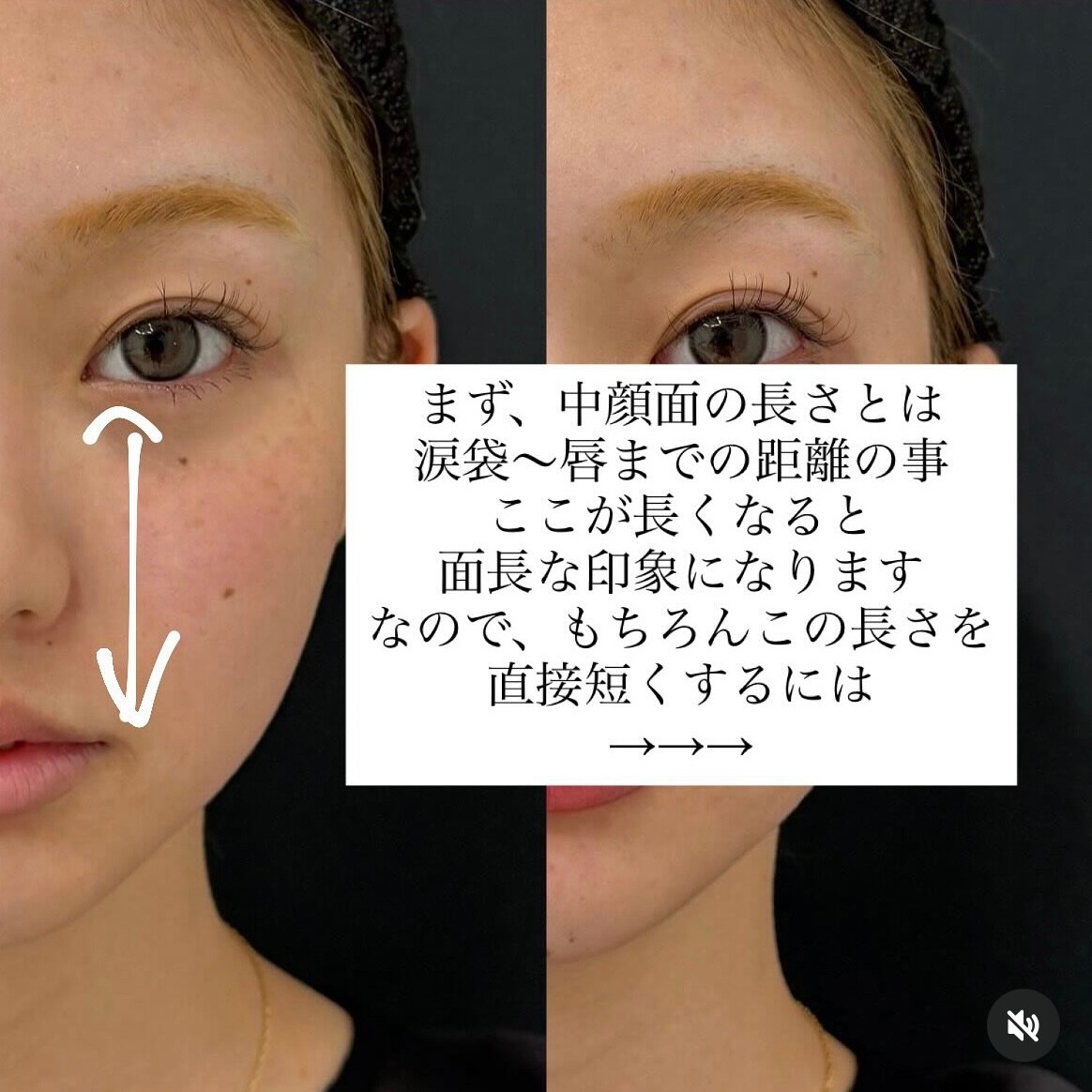 ヒアルで“短くする”だけではなく“短く見せる”こともできる
